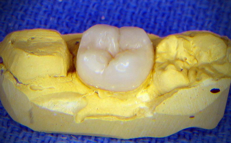 Crown Lower Molar