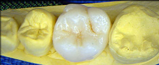 molar crown
