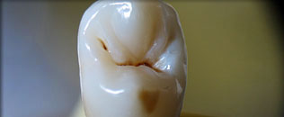 bicuspid